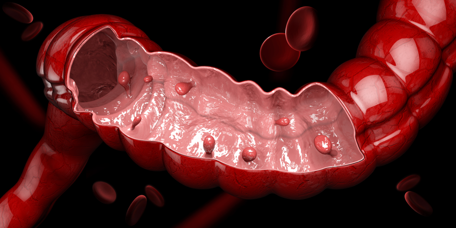 大腸癌ポリープのイメージ