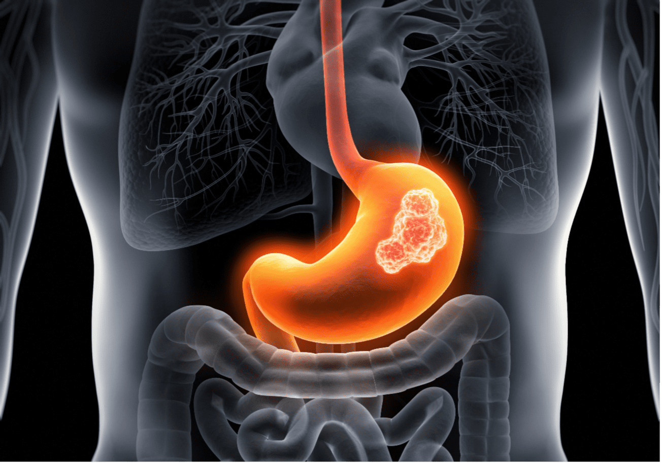 胃癌のイメージ