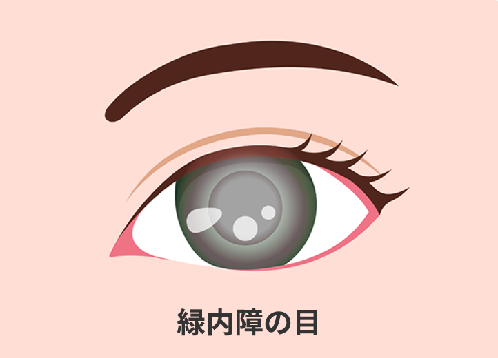 白内障の目