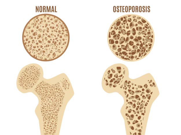 骨粗鬆症の状態のイラスト