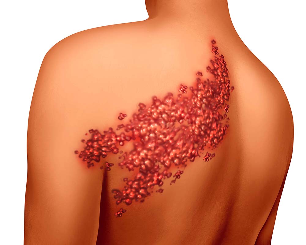 帯状疱疹のイメージ